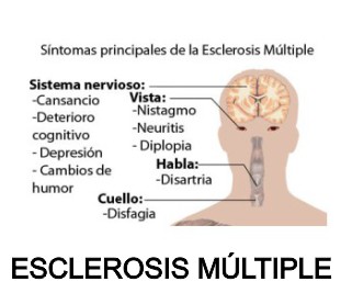 esclerosis multiple nova