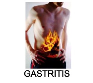 gastritis fibramor ulcer