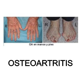 osteoartritis artriplus nova moringapura oroverde