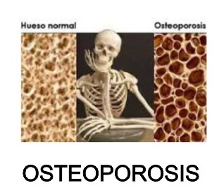 osteoporosis moringapura oroverde