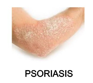 psoriasis aceite de moringa