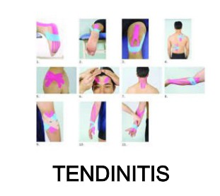 tendinitis artriplus